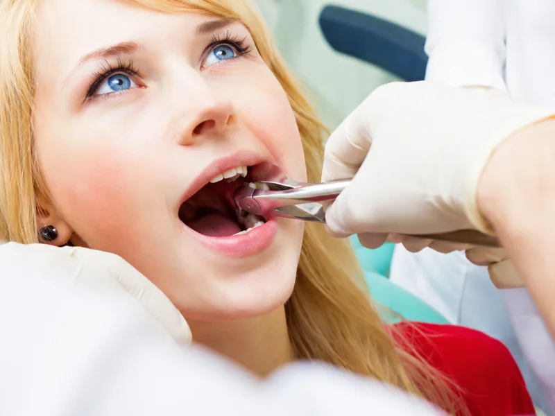 Dentist using extraction forceps during a wisdom tooth extraction procedure